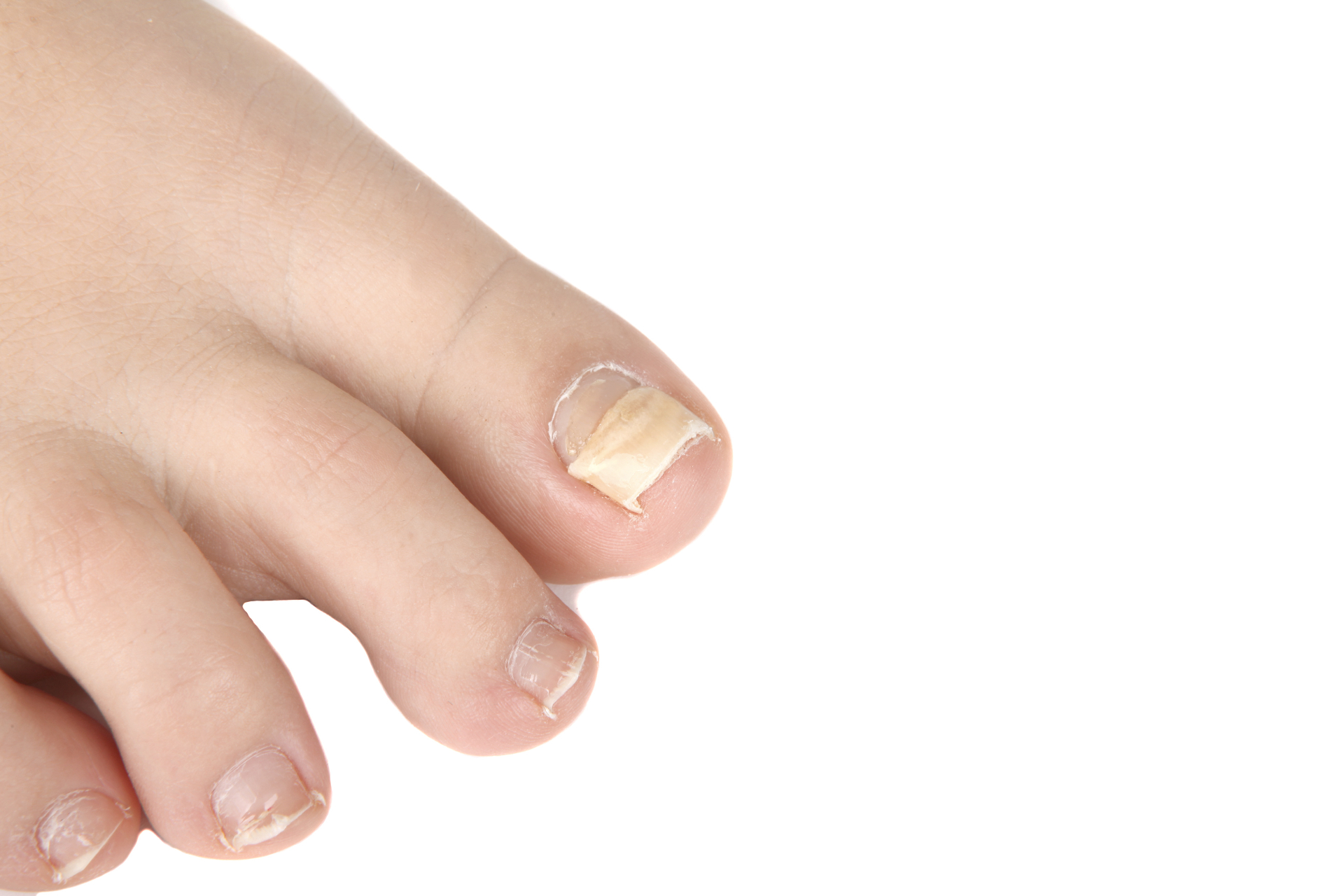Fungal Nail Infection