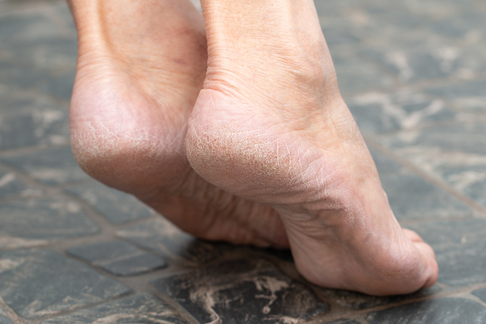 Heel & Cracked Skin