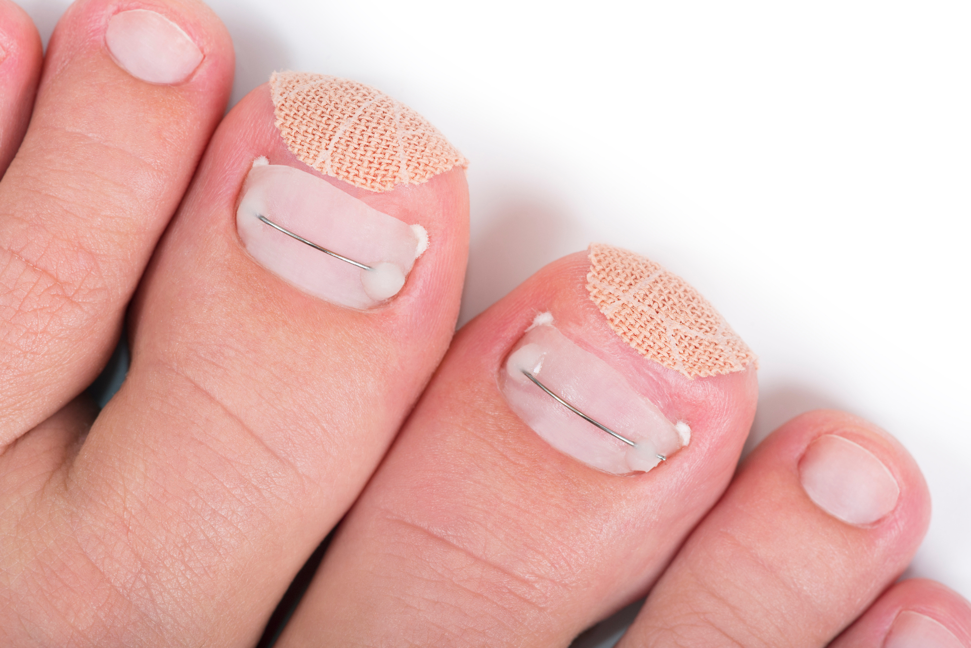 Nail Bracing